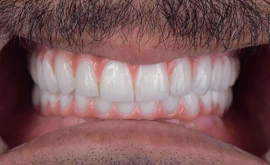 Best Dental Implants in Dubai