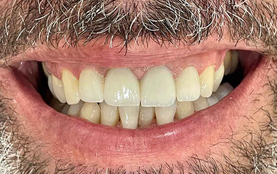 Implant and Crowns