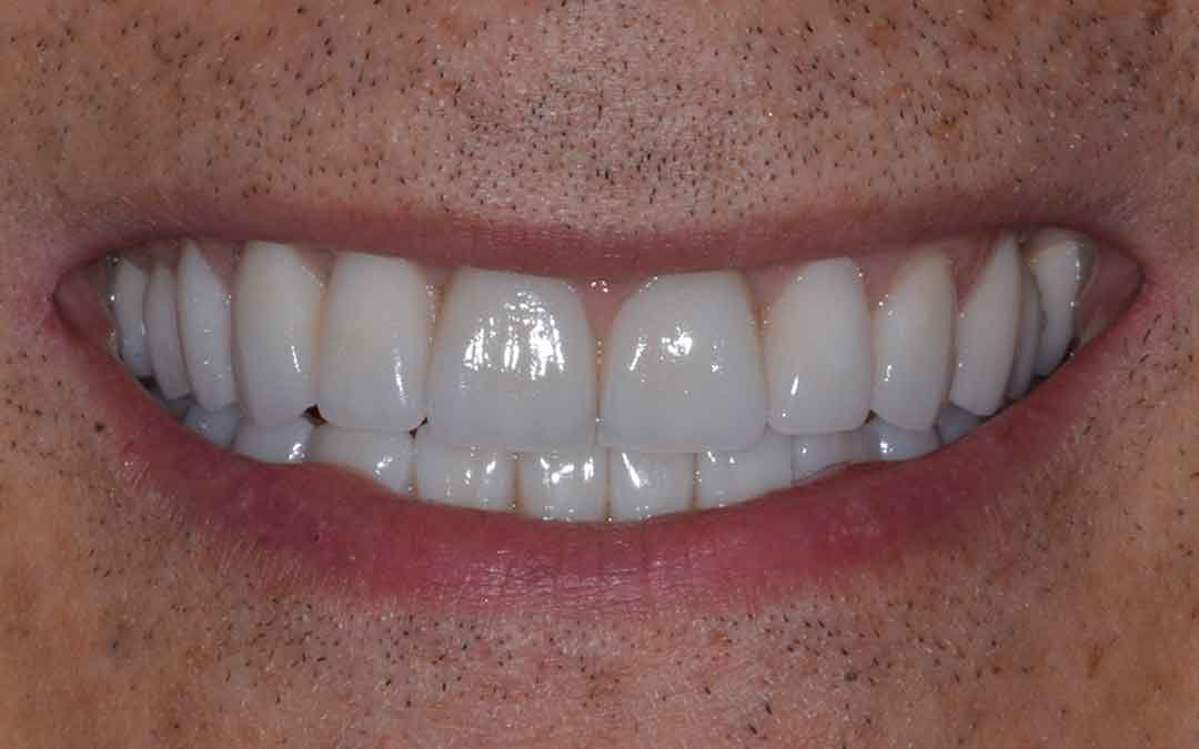 After Crowns & Occlusal Rehabilitation