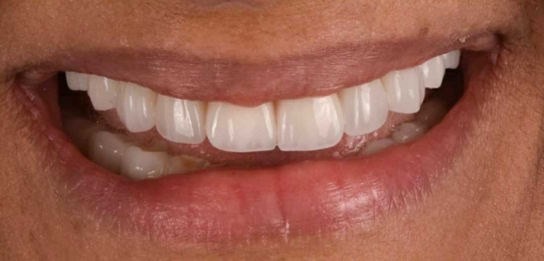 Hollywood Smile Makeover