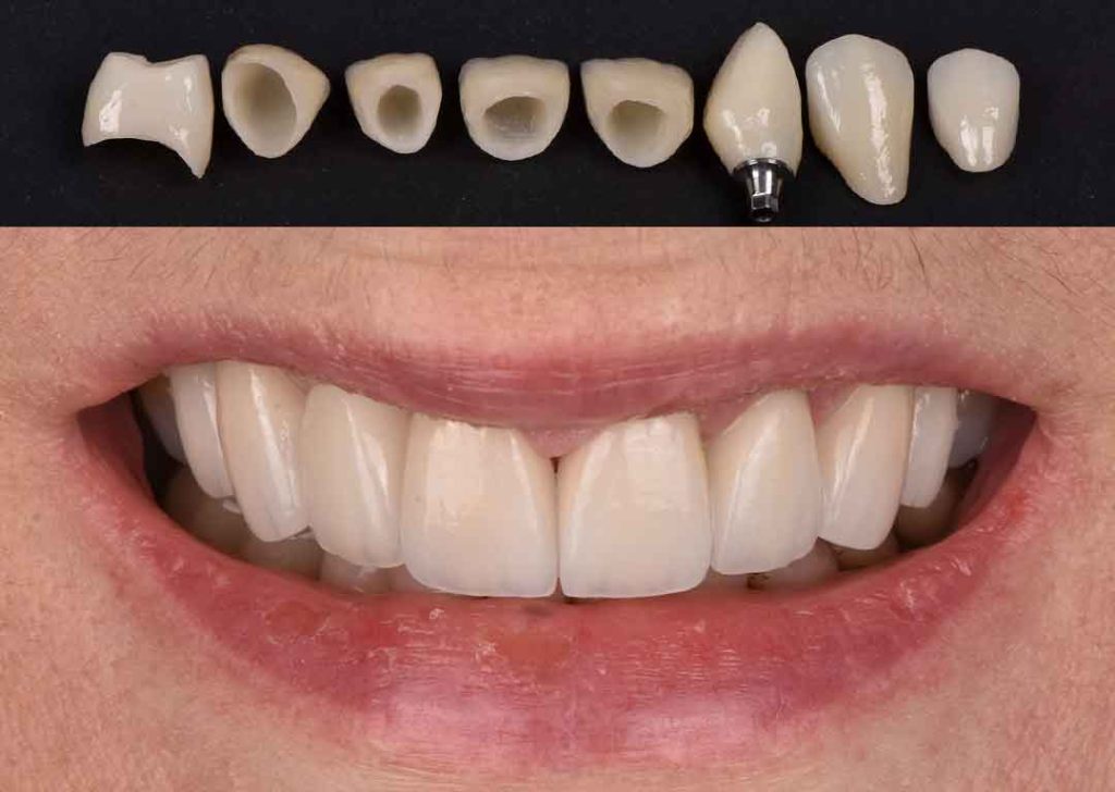 crowns veneers implant crown a