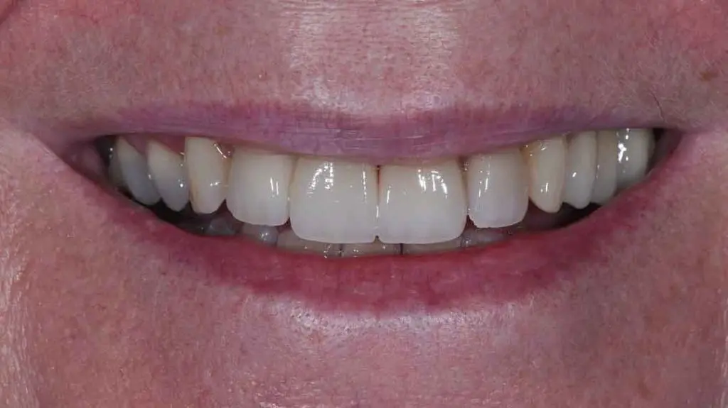 dental bridges 01a