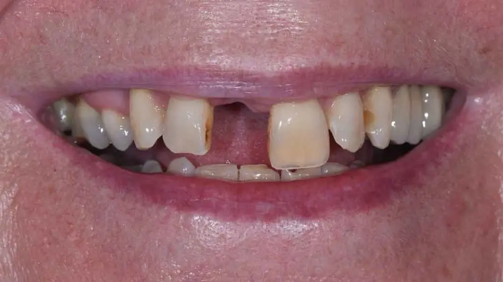 dental bridges 01b 1