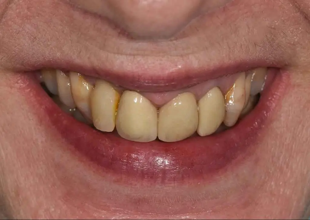 dental crowns 01b