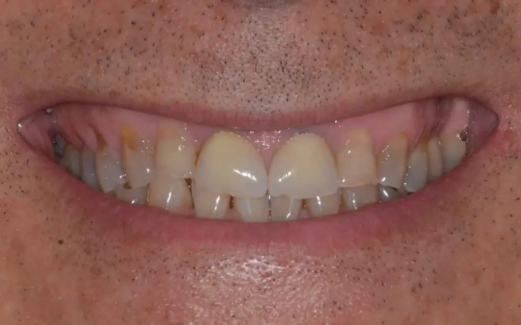 dental crowns 03b