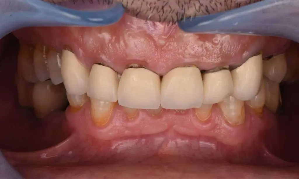 dental crowns 06b