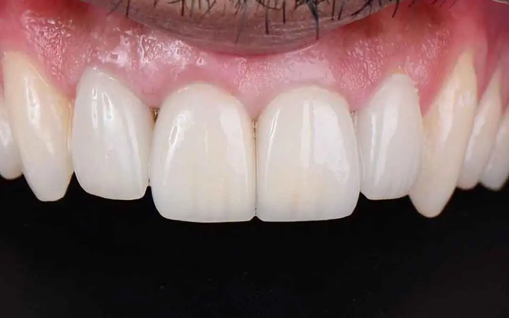 dental crowns 4a