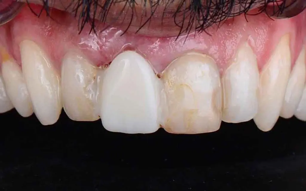 dental crowns 4b
