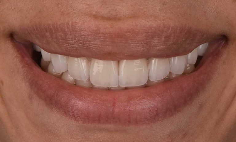 dental-veneers-02a