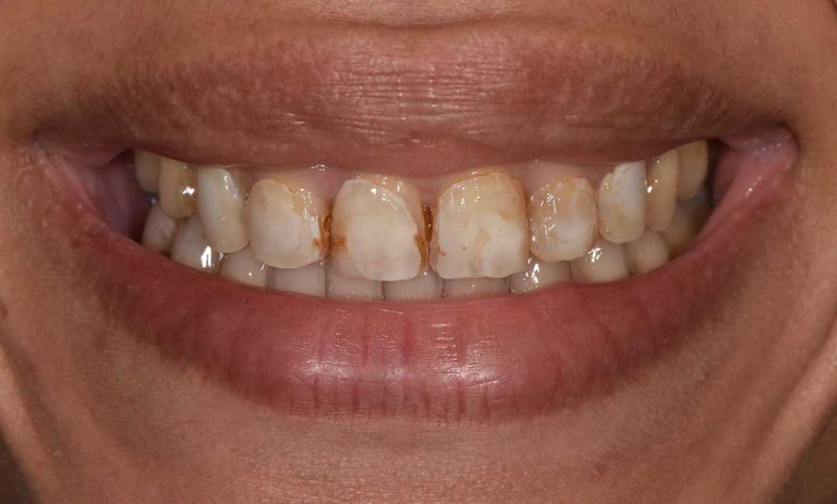 dental-veneers-02b