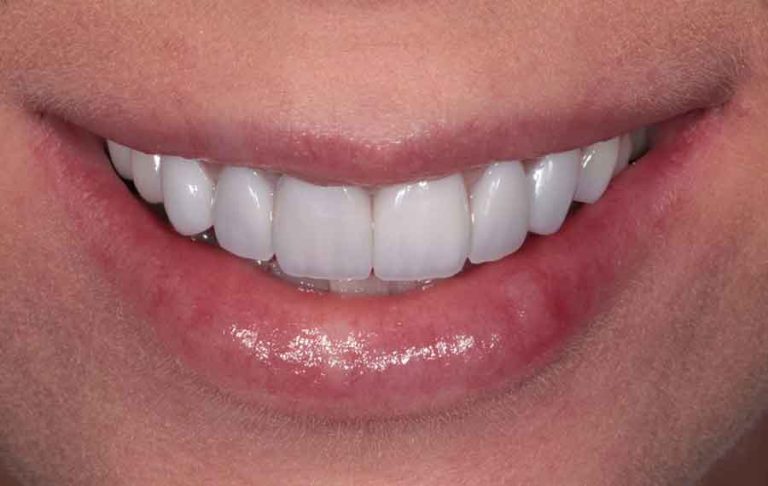 dental-veneers-03a