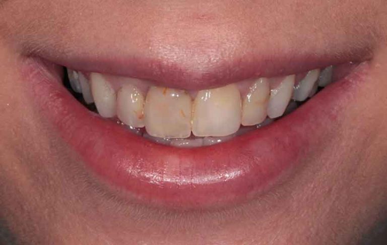 dental-veneers-03b