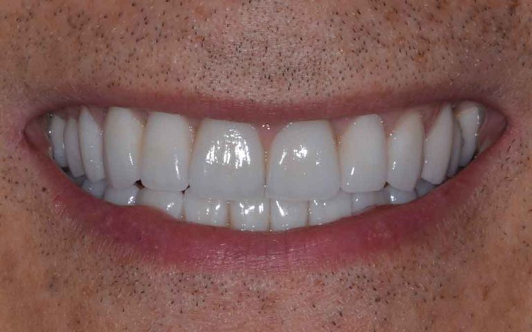 dental-veneers-06a