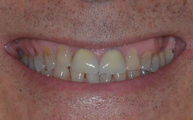 dental-veneers-06b