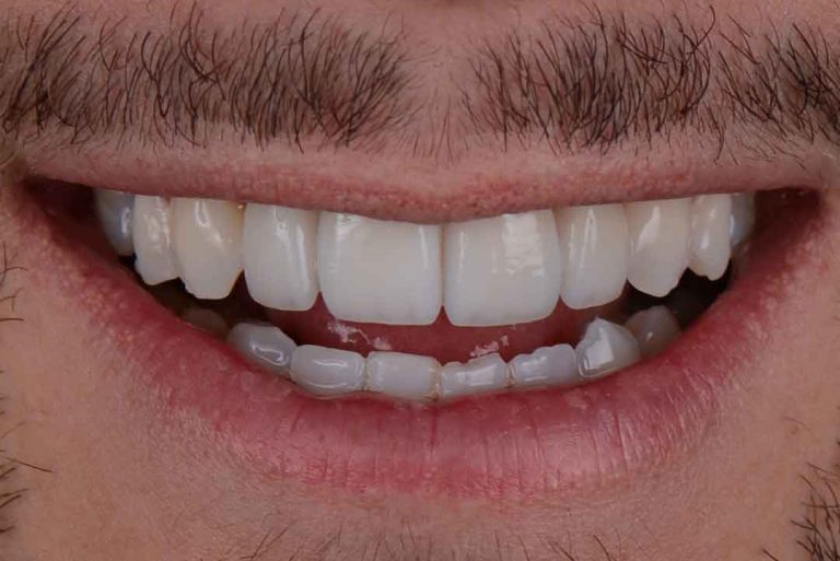 dental-veneers-07a