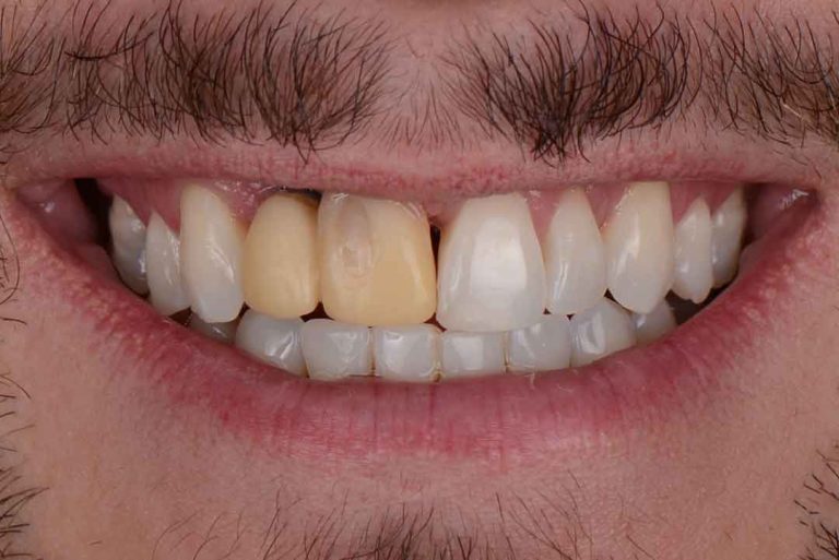 dental-veneers-07b