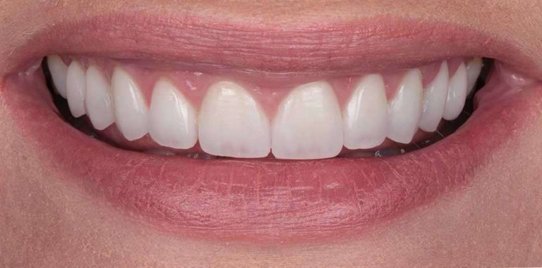 feldspathic-veneers-01a (1)
