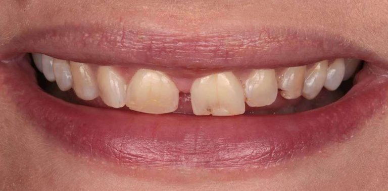 feldspathic-veneers-01b (1)