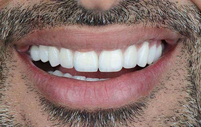 veneers-01a