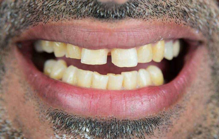 veneers-01b