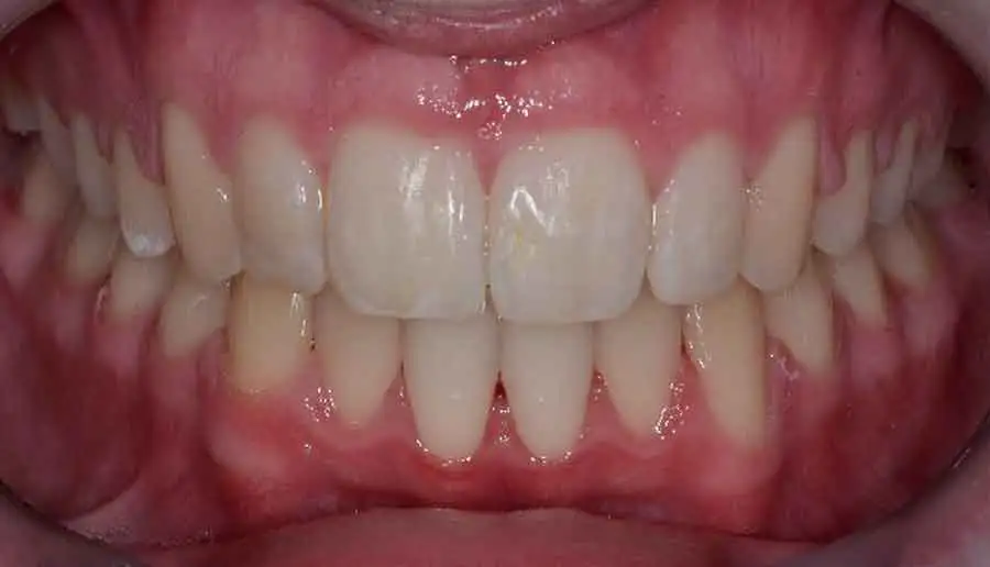 damon braces 01a 1