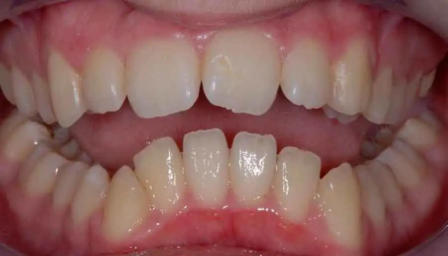 damon braces 01b 1