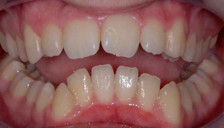 damon-braces-01b