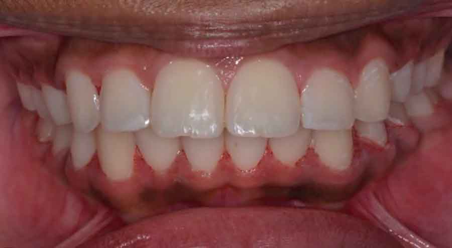 Damon Braces 5 damon braces 02a 1