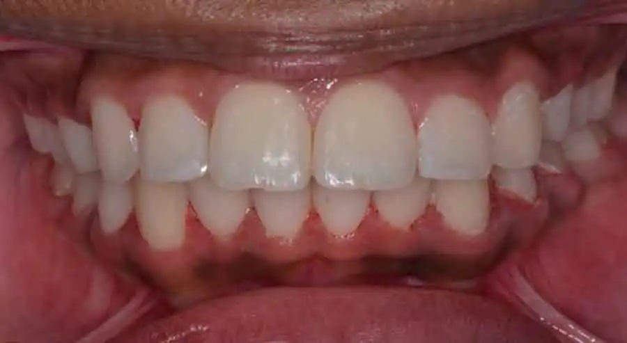 damon braces 02a 1