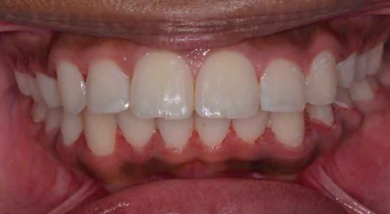 Braces and Aligners 6 damon-braces-02a