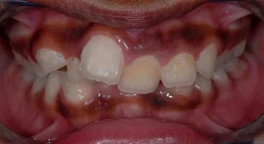 damon braces 02b 1