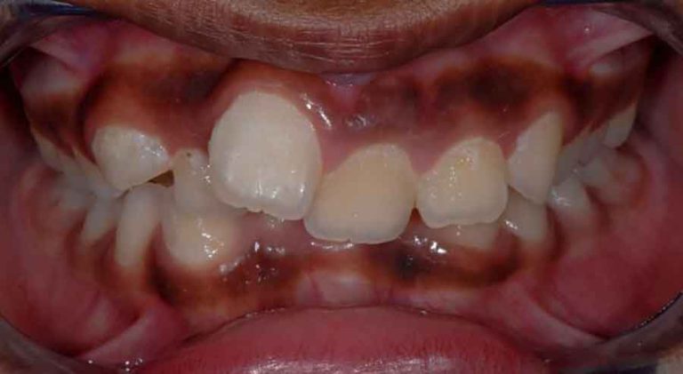 damon-braces-02b