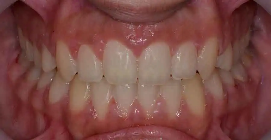 damon braces 03a