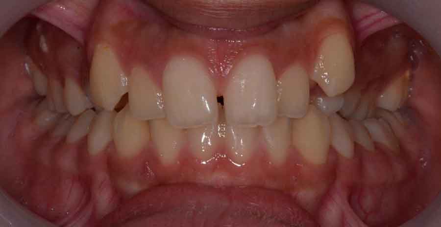 Damon Braces 6 damon braces 03b