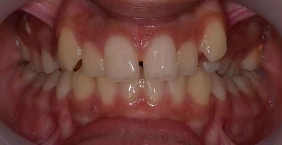 damon braces 03b