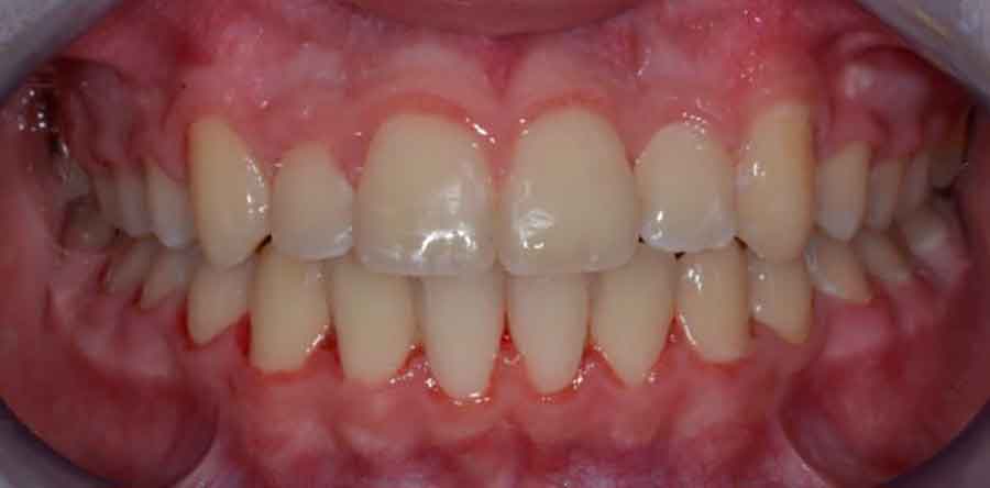 Damon Braces 9 damon braces 04a 1