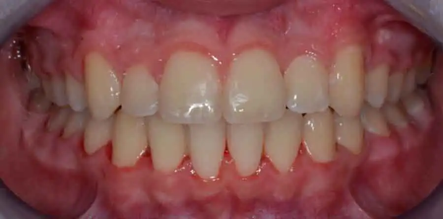 damon braces 04a 1
