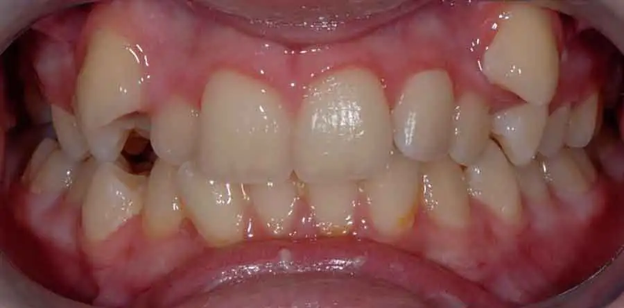 damon braces 04b 1
