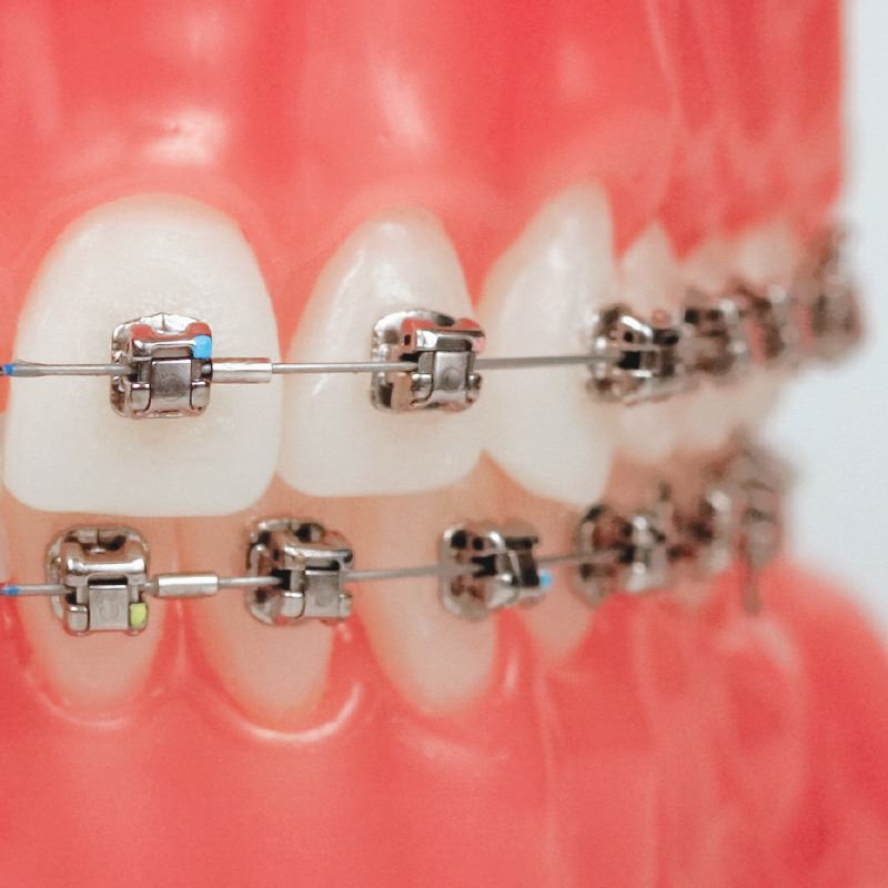 Damon Braces 11 damon braces 1