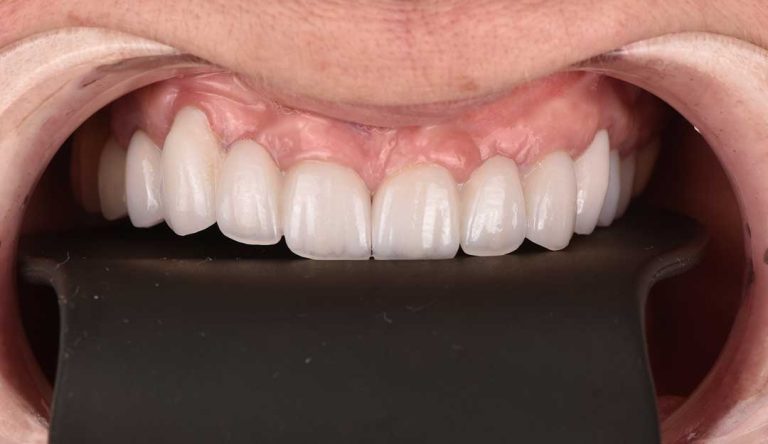 dental-implants-04a