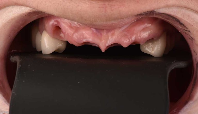 dental-implants-04b