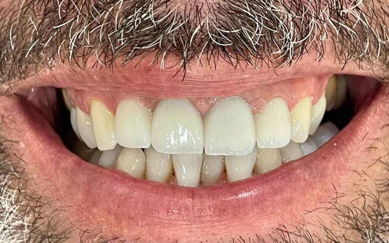 dental-implants-05a