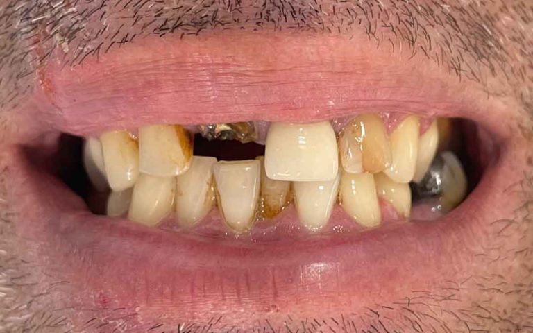 dental-implants-05b