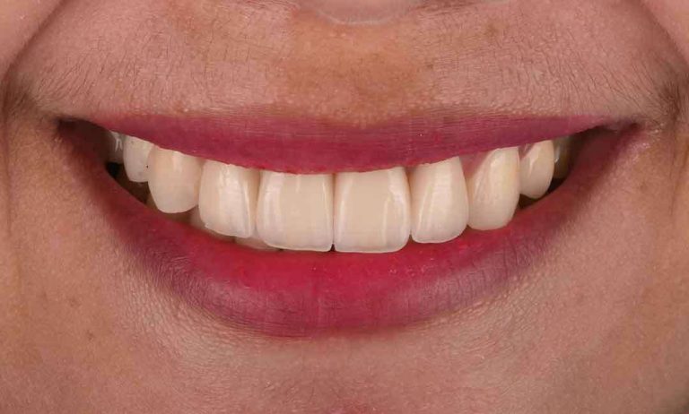 dental-implants-07a