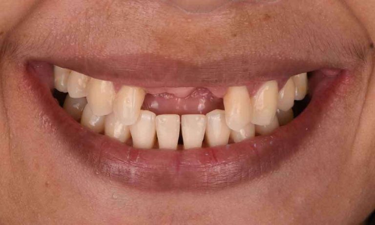dental-implants-07b