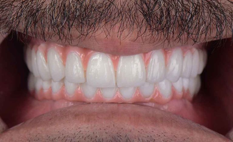 full-dental-implants-01a