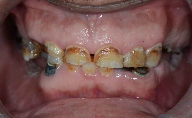 full-dental-implants-01b