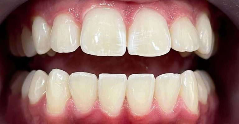 in-office-teeth-whitening-02a