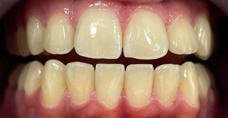 in-office-teeth-whitening-02b