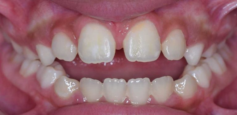 metal-braces-01b